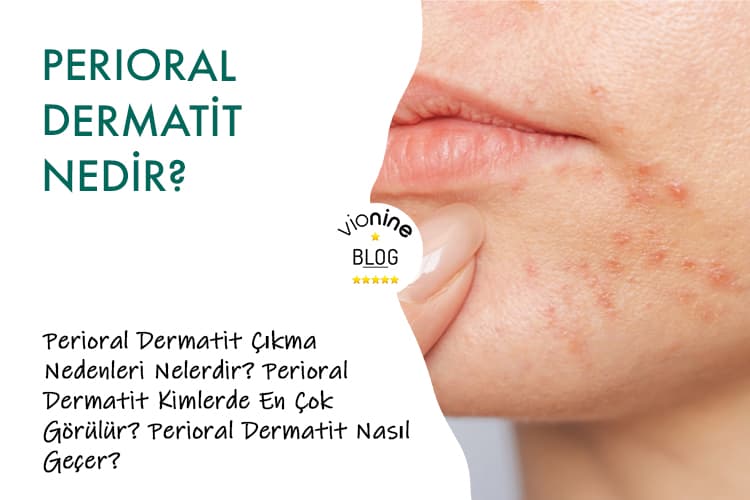 Perioral Dermatit Nedir?