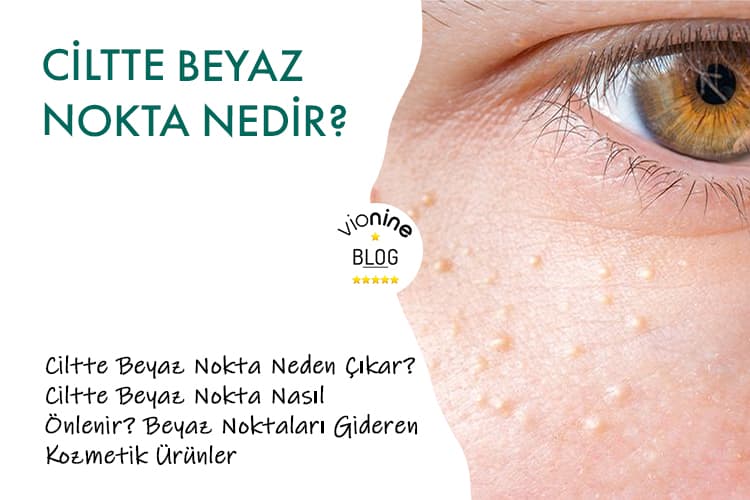 Ciltte Beyaz Nokta Nedir?