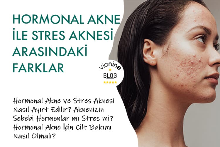 Hormonal Akne ile Stres Aknesi Arasındaki Farklar