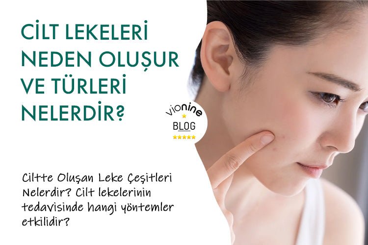 Cilt Lekeleri Neden Oluşur ve Türleri Nelerdir? - Vionine