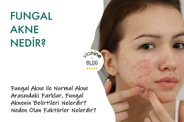 Fungal Akne Nedir? - Vionine