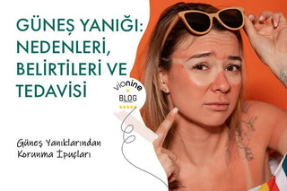 Güneş Yanığı Nedenleri Belirtileri ve Tedavisi