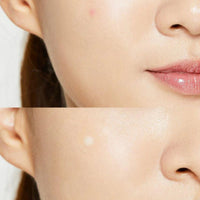 COSRX Acne Pimple Master Patch - Sivilce Bandı 24 Adet