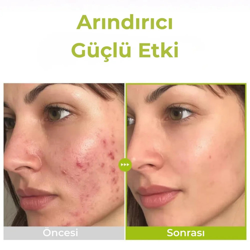 PURITO SEOUL Azelaic Acid 10 Kojic & Tea Tree Serum - Leke Karşıtı 30ml