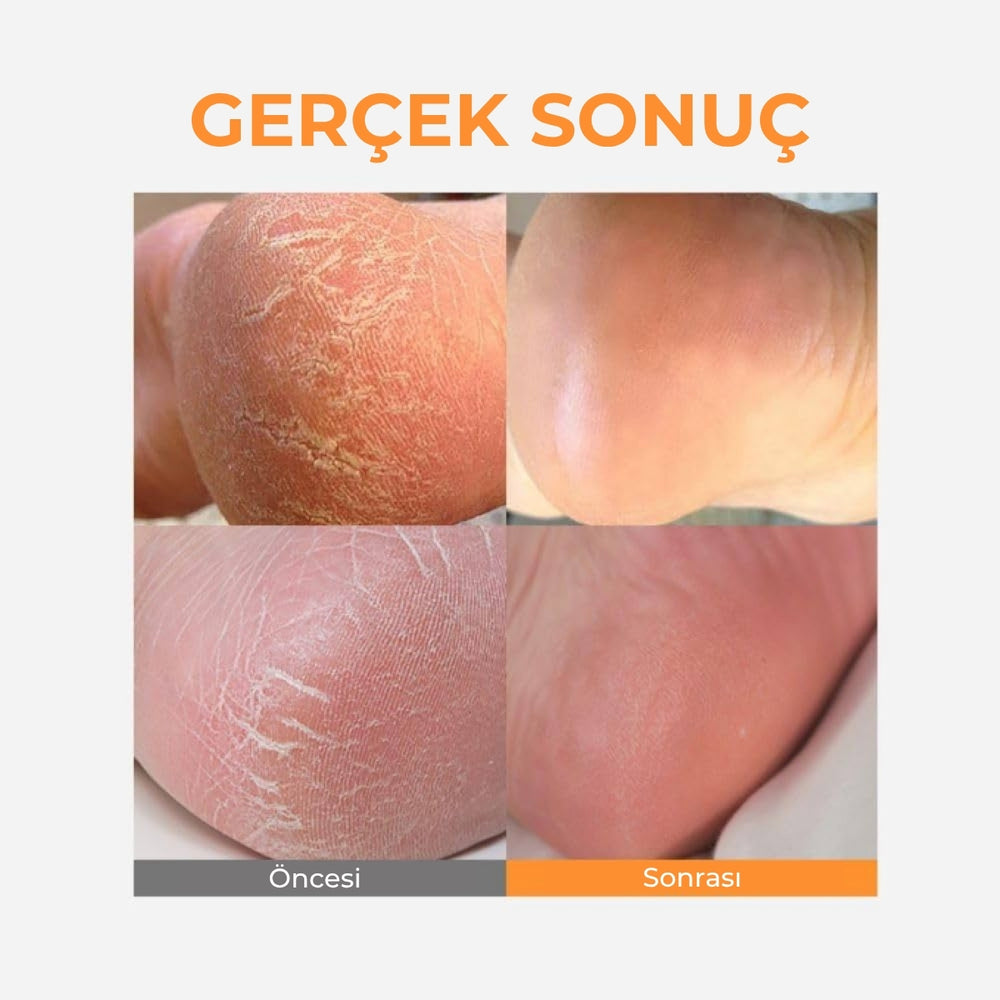 Sungboon LHA Baby Foot Scrub Stick - Ayak Peelingi 20gr