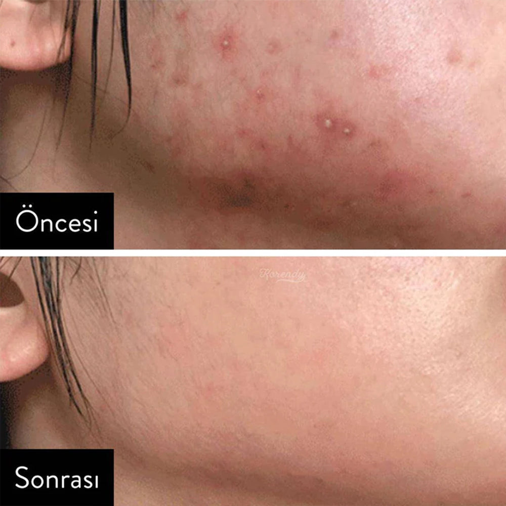 SOME BY MI AHA-BHA-PHA 30 Days Miracle Toner - Gözenek Toniği 150ml