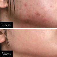 SOME BY MI AHA-BHA-PHA 30 Days Miracle Toner - Gözenek Toniği 150ml