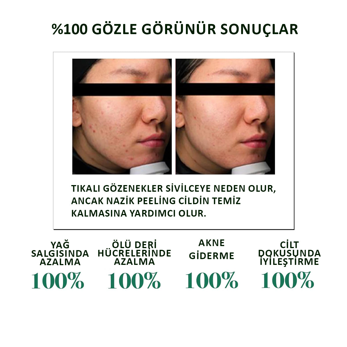 Pürüzlü cilt dokusu ve ölü deri görünümü için AHA, BHA ve PHA üçlü asit kompleksi içeren nazik 30 günlük peeling toniği.