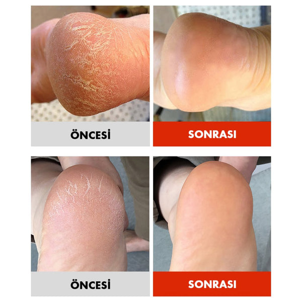 Sungboon Editor Shea Butter Baby Foot Stick / Nasırlaşmış ve Çatlamış Topuk Bakım Sticki - SUNGBOON EDITOR - Vionine